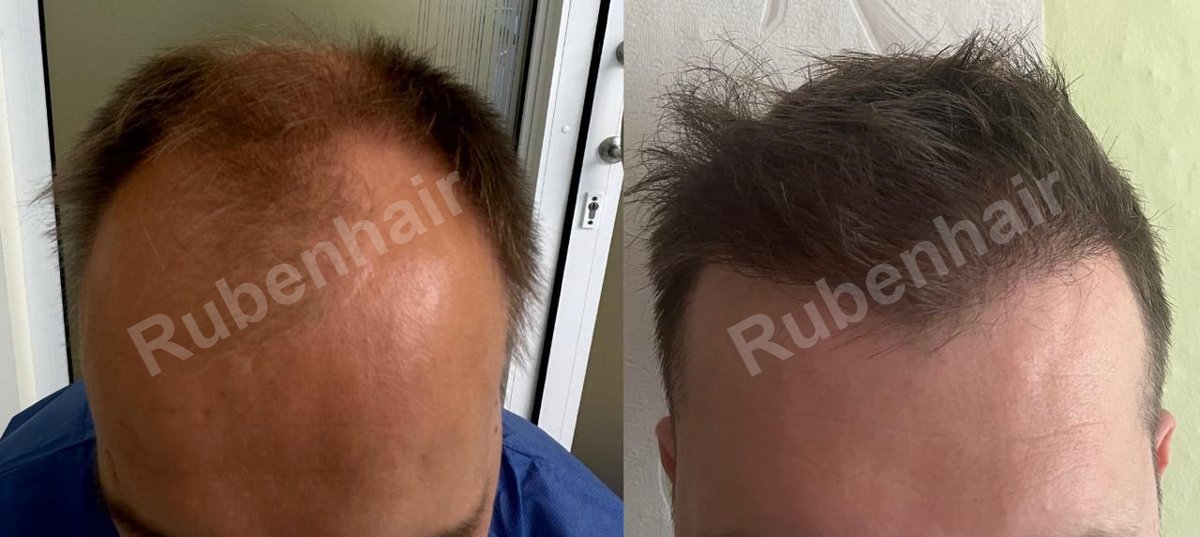 Crown restoration — Before / After