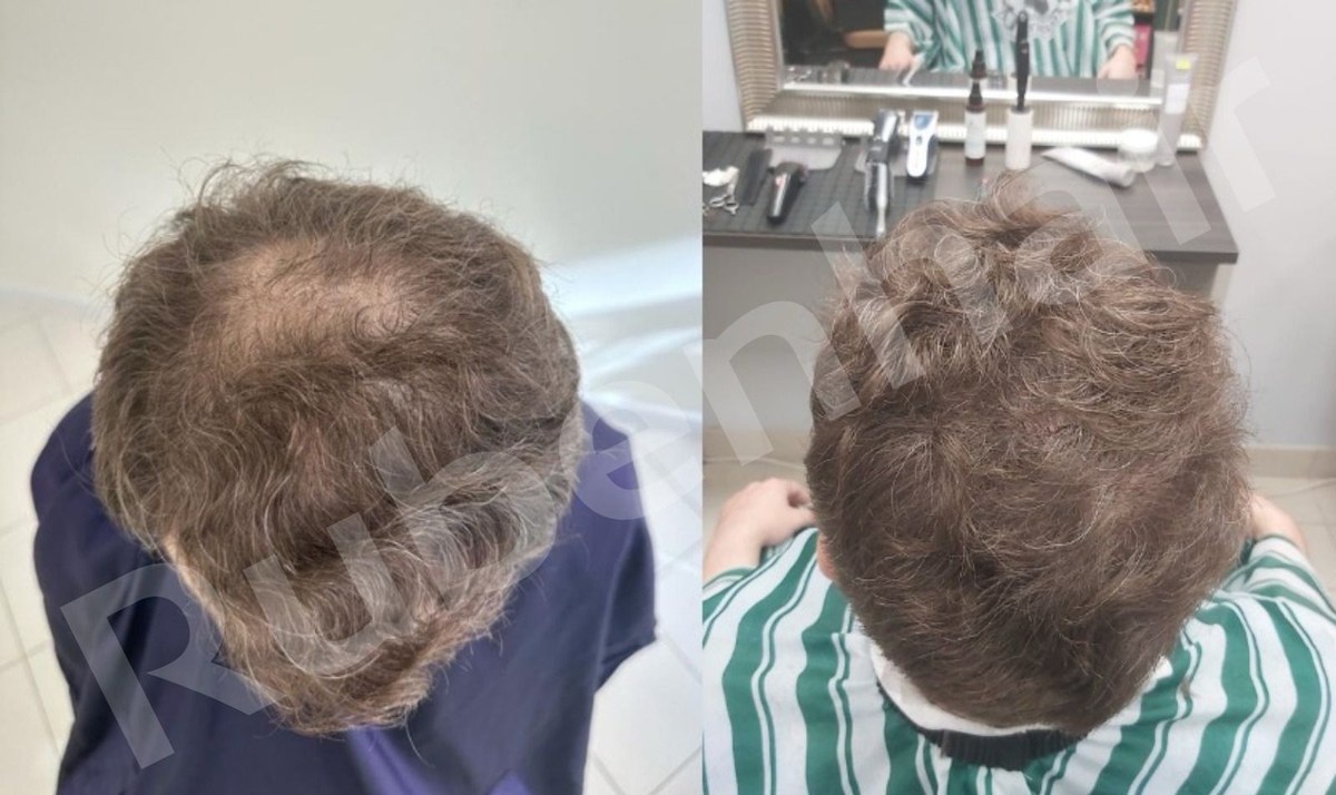 Mid-scalp restoration — Before / After
