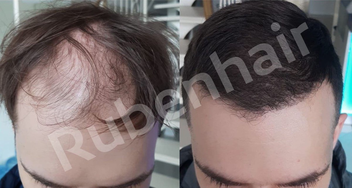 Frontal hairline restoration — Before / After