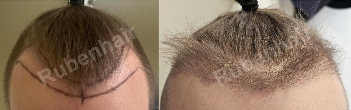 Frontal hairline — Before / After