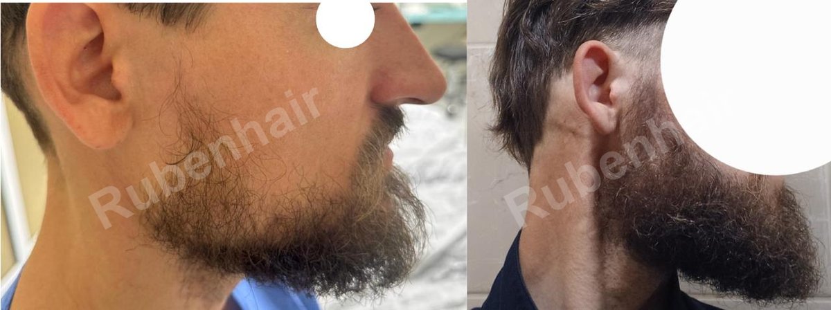 Beard transplant — Before / After