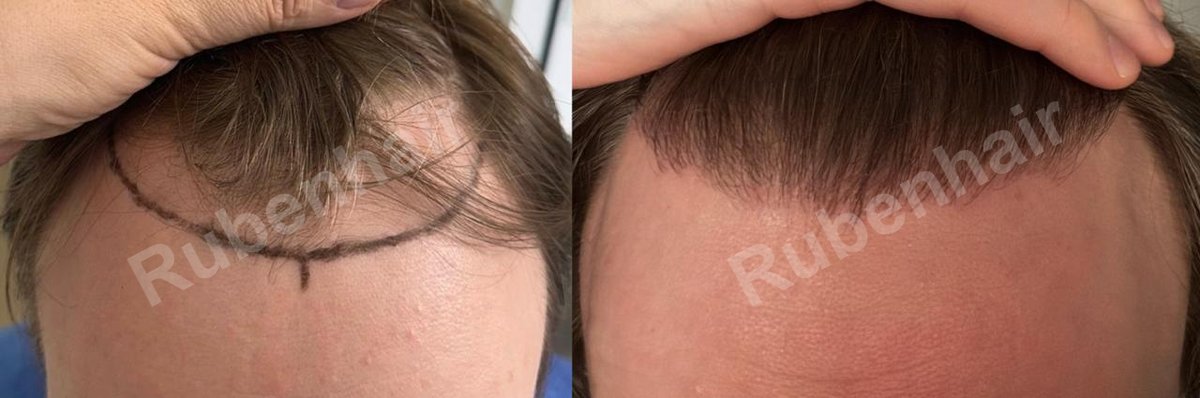 Hairline & frontal zone — Before / After