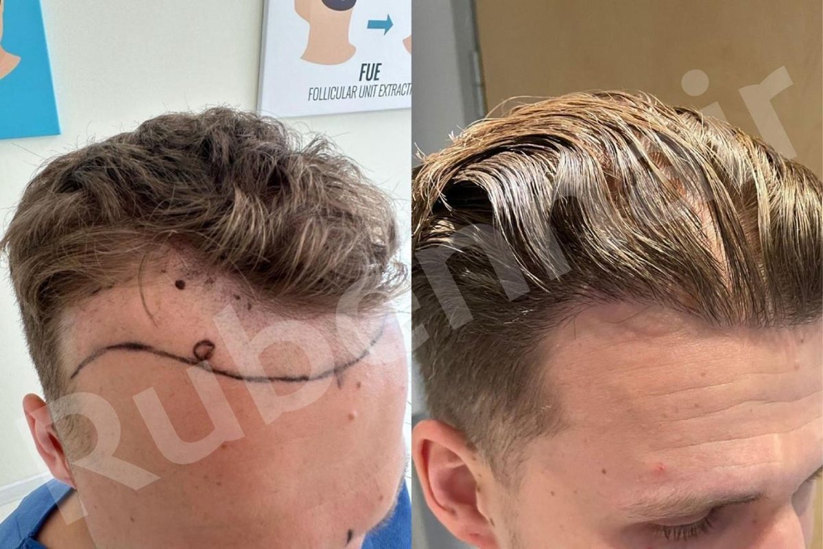 Hairline reconstruction — Before / After