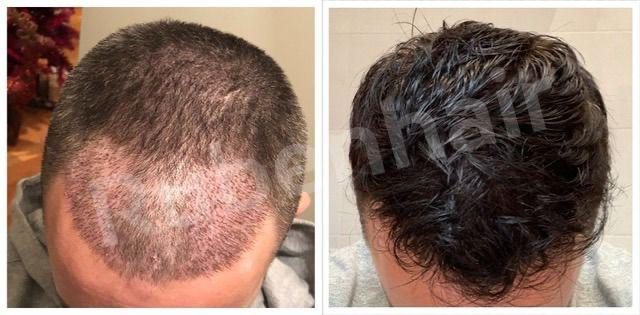Crown & mid-scalp — Before / After