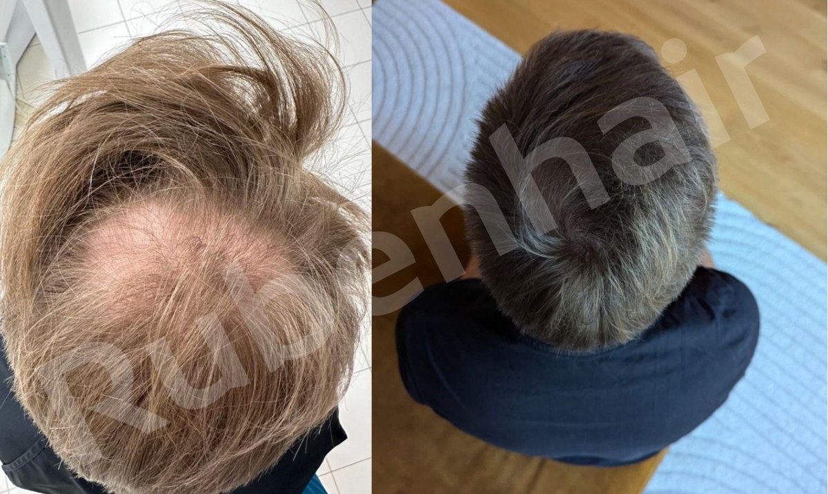 Crown density restoration — Before / After