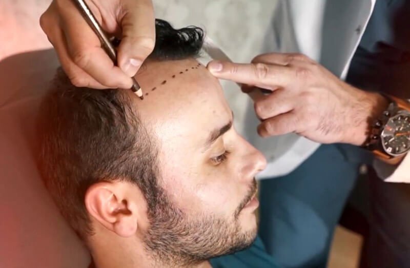 FUE Hair Transplant